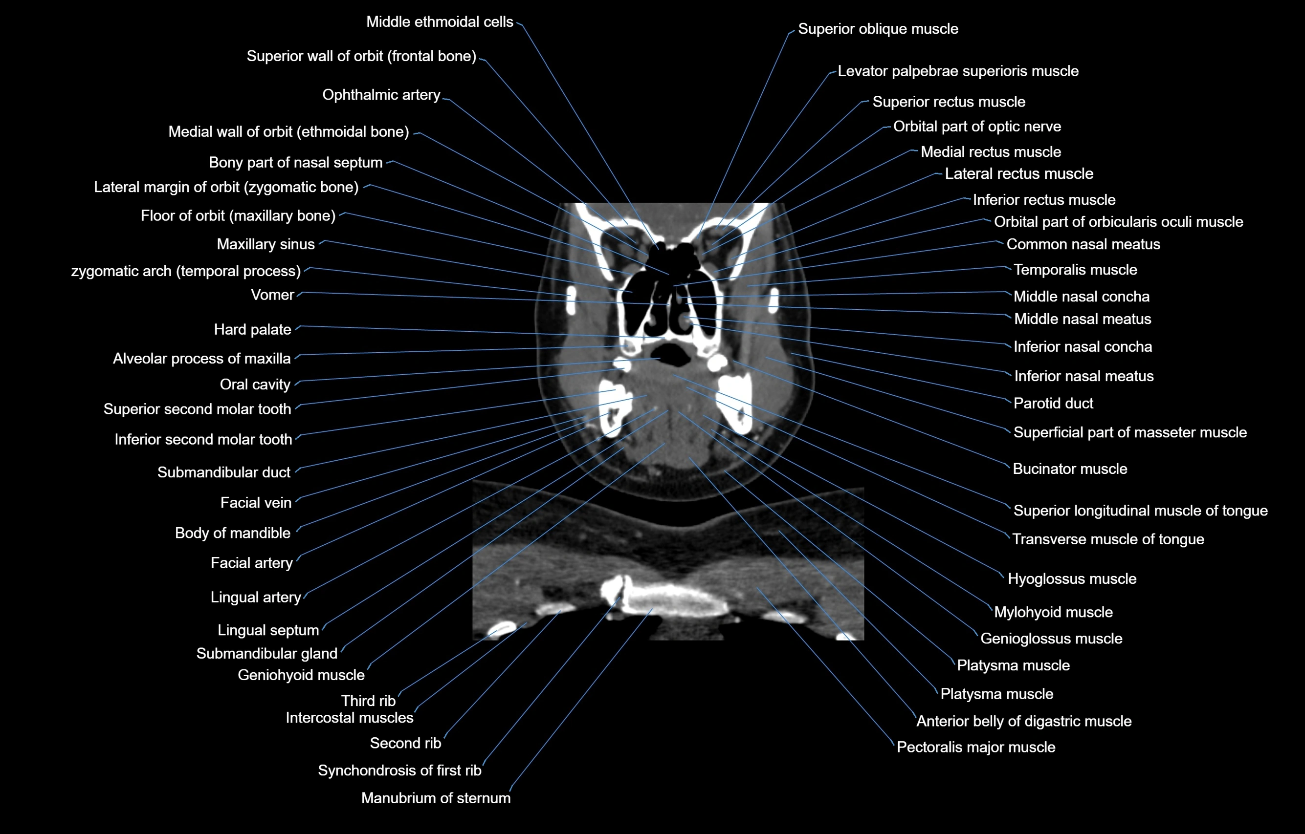 CT Neck coronal  cross sectional anatomy labelled 3D  radiology  image-00021.webp